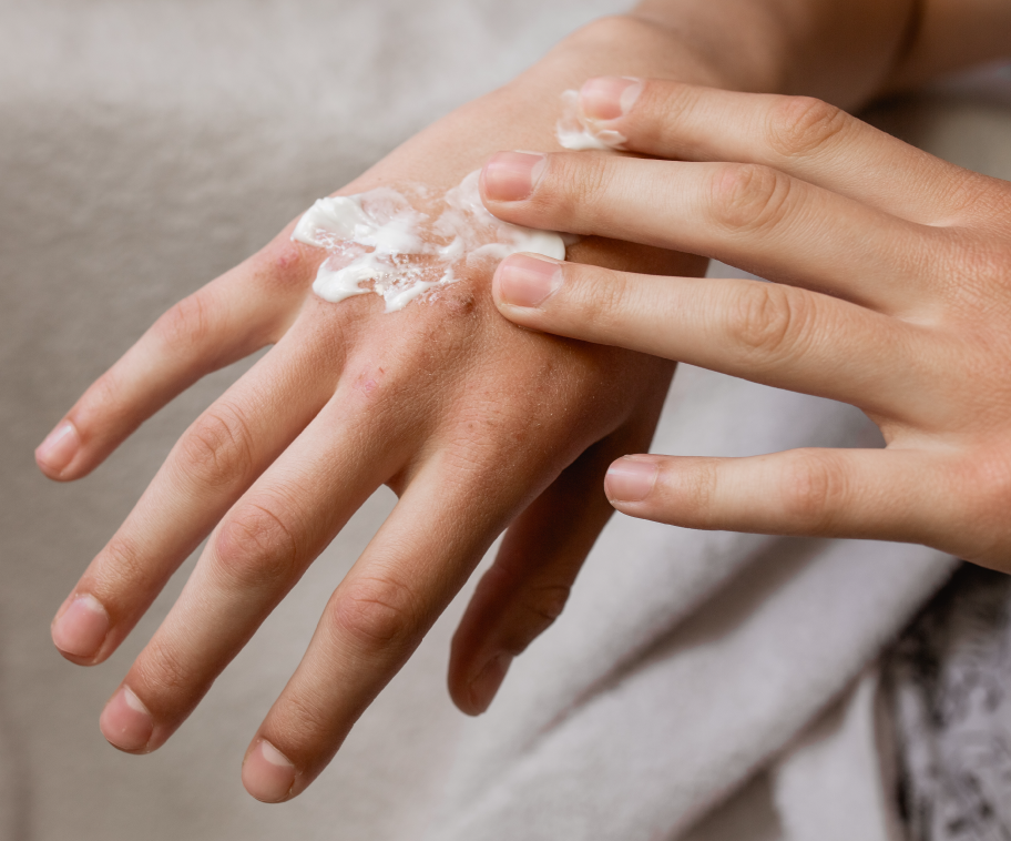 Doctor Rogers Skincare Blog: Effective Remedies for Eczema: A Comprehensive Guide