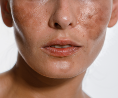 How to Treat Brown Spots and Hyperpigmentation