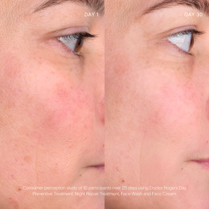 Middle Aged women displaying skin care results including reduce redness and inflammation on right cheek after using Doctor Rogers Day Preventive Treatment, Night Repair Treatement, Face Wash and Face Cream for 28 days in a consumer perception study 