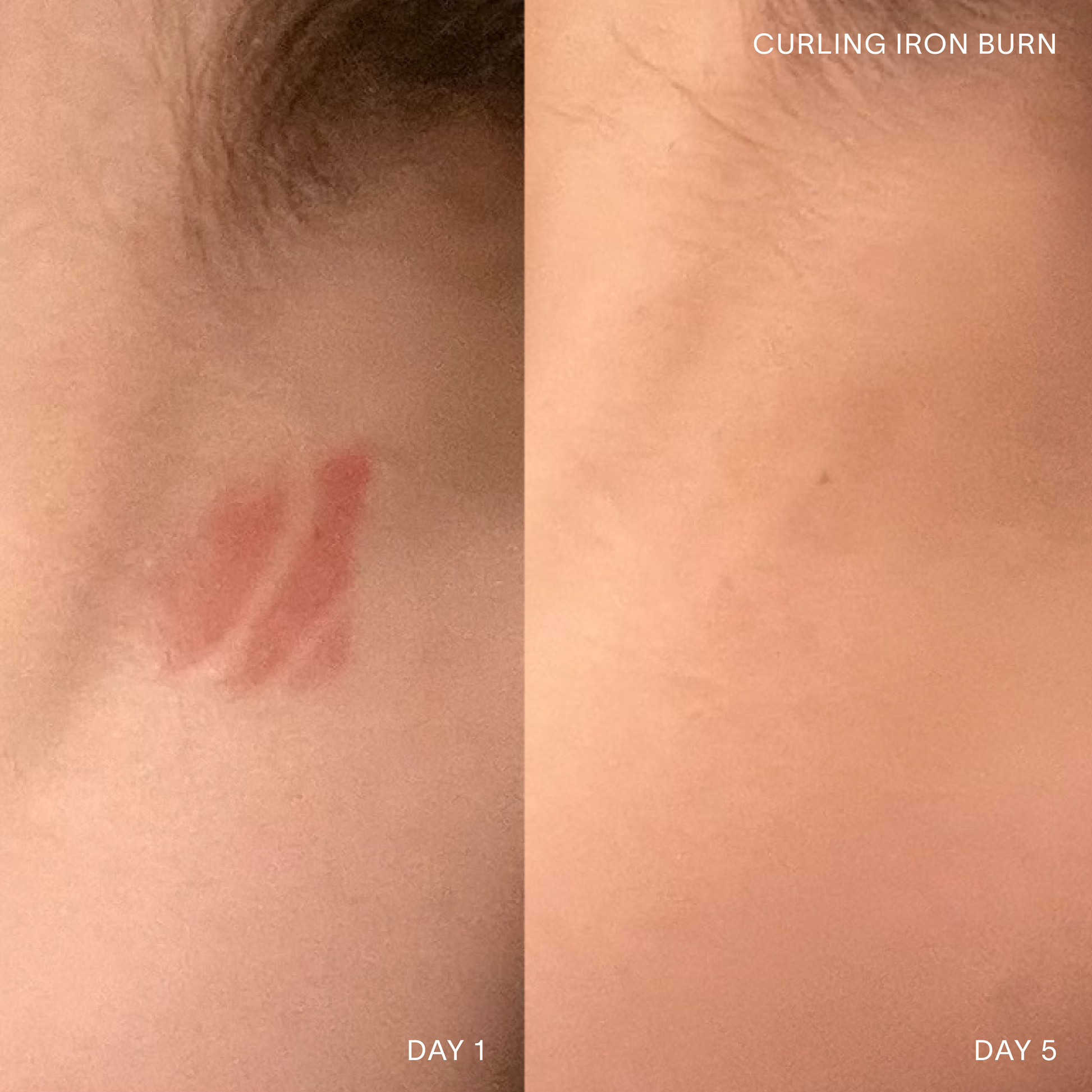 Before and After 5 day results of curling iron burn healed with Doctor Rogers Restore Healing Balm