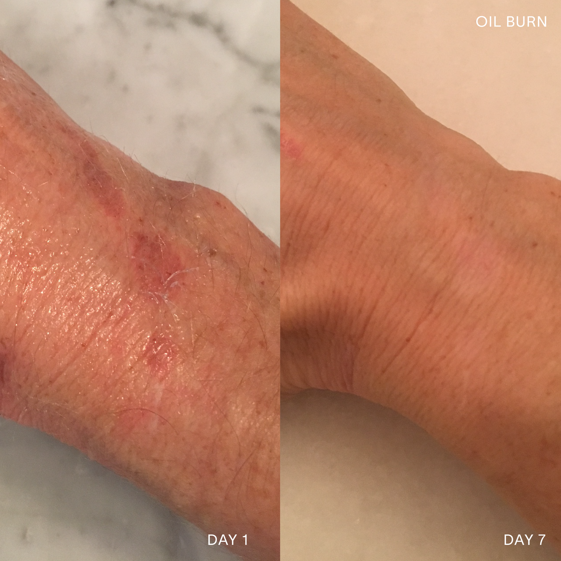 Before and After 7 Day Results of using Doctor Rogers Restore Healing Balm to quickly heal a burn on the wrist