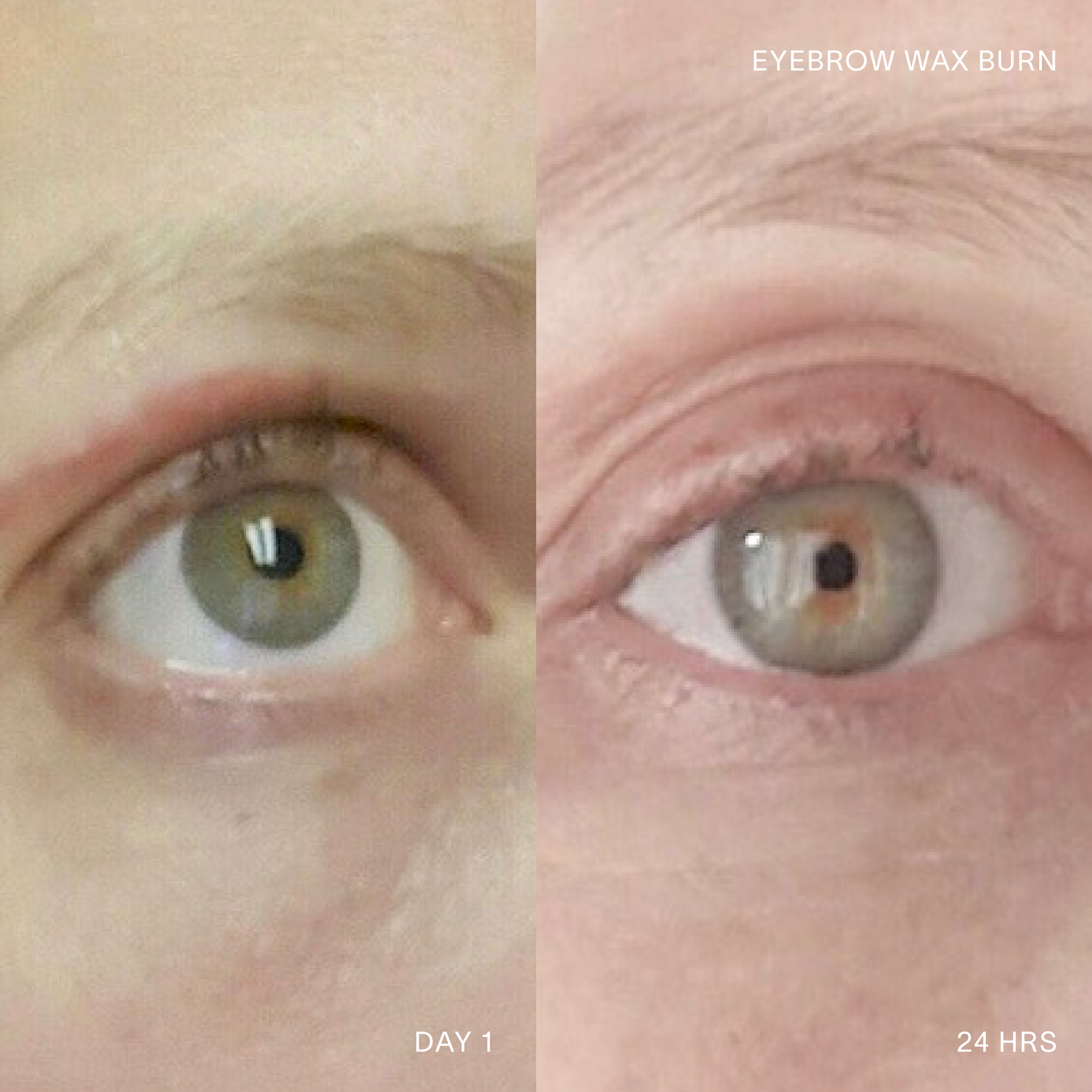 Before and after 24 hour results of Doctor Rogers Restore Healing Balm to heal skin injured from an eyebrow wax burn 